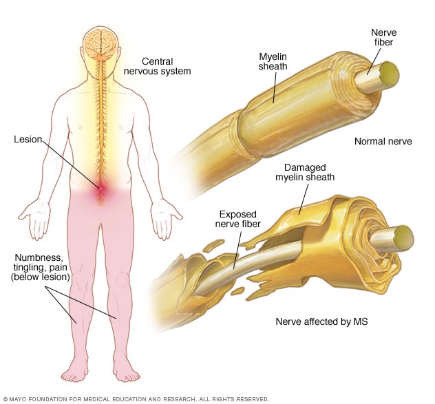 Multiple sclerosis - Symptoms and causes - Mayo Clinic
