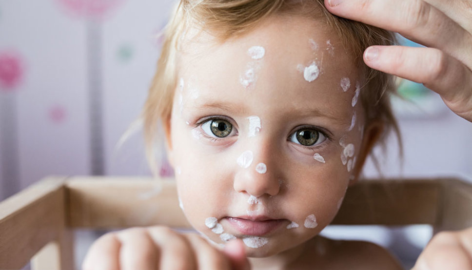 What Is Chickenpox? Who Gets It? Should You Vaccinate? | Lifespan